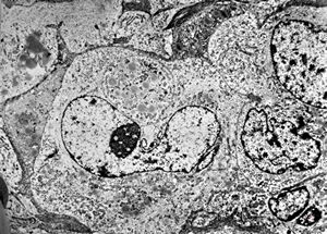 M,64y. | liposarcoma v.s. M,64y. | liposarcoma v.s.